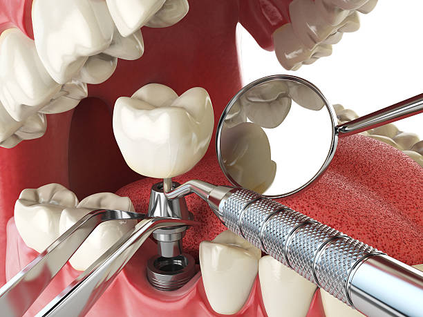 Best Emergency Tooth Extraction in Antigo, WI
